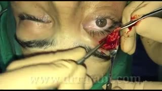 جراحی تومور بزرگ کاسه چشم و گسترش آن تا نزدیکی مغز