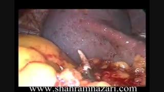 طحال‌برداری یا اسپلنکتومی توسط دکتر شهرام نظری مزوتراپی