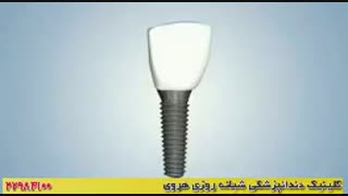 فیلم ایمپلنت دندان ها