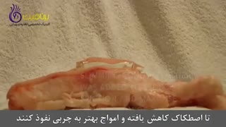 عملکرد دستگاه کویتیشن بر روی چربی ها چگونه است؟