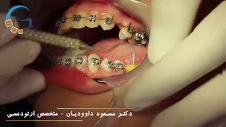 ارتودنسی دندان روکش شده | دکتر مسعود داوودیان