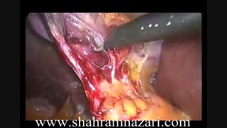 فیلم جراحی لاپاروسکوپی برداشتن کیسه صفرا ی ساعت شنی