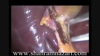 عمل جراحی برداشتن کیسه صفرا توسط دکتر شهرام نظری