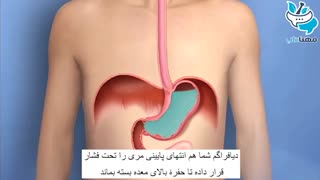 علت ترش کردن و ریفلاکس معده
