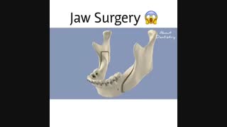 جراحی عقب بودن فک پایین - دکتر سهراب آصفی