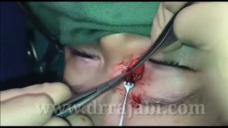 کودک هشت ماهه ای با توده درموئید مادرزادی