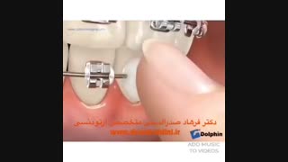 ارتودنسی قبل و بعد