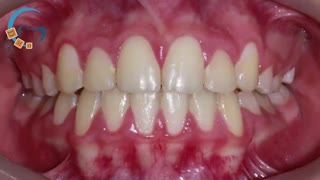 بعد از ارتودنسی، ملاحظات و مراجعات |دکتر مسعود داوودیان