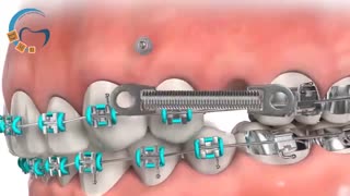 مینی اسکرو جهت قرینگی در ارتودنسی | دکتر مسعود داوودیان