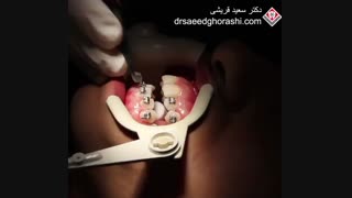 براکت گذاری در ارتودنسی-دکتر سعید قریشی