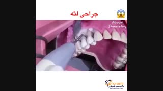 جراحی لثه-دکتر سعید قریشی