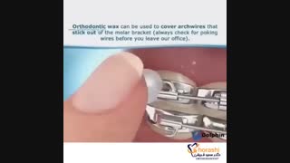 موم و وکس در ارتودنسی-دکتر سعید قریشی