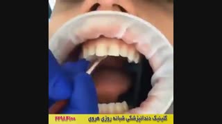 کامپوزیت دندان ها در تهران توسط بهترین ها