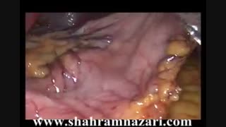 جراحی اسلیوگاسترکتومی یا همان اسلیو معده توسط دکتر شهرام نظری دندان مصنوعی