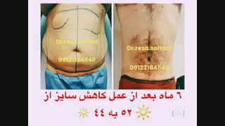 لیپوماتیک شکم و پهلو