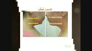 لیپوماتیک غبغب