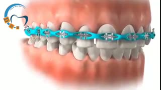 ارتودنسی دندان های فاصله دار | دکتر مسعود داوودیان