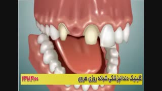 بریج دندان ها در تهران