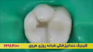 پر کردن دندانها با  کامپوزیت