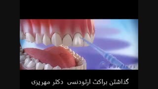 مراحل گذاشتن براکت ارتودنسی ثابت روی دندان