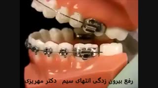 بیرون زدگی انتهای سیم ارتودنسی