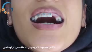 ارتودنسی دندان های غایب و نهفته | دکتر مسعود داوودیان