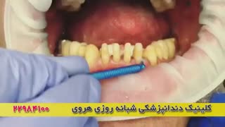 ونیر دندان در کیلینیک دندانپزشکی خوب در تهران