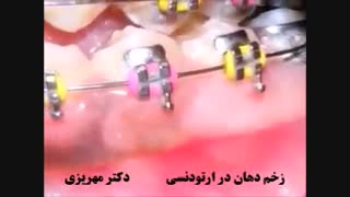 زخم دهان در ارتودنسی