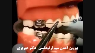 بیرون آمدن سیم ارتودنسی
