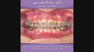 قبل و بعد ارتودنسی بیمار شماره 118 | دکتر همت پور
