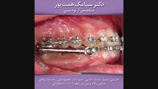 قبل و بعد ارتودنسی بیمار شماره 118 | دکتر همت پور