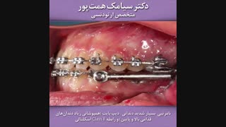 قبل و بعد ارتودنسی بیمار شماره 118 | دکتر همت پور