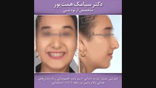 قبل و بعد ارتودنسی بیمار شماره 118 | دکتر همت پور