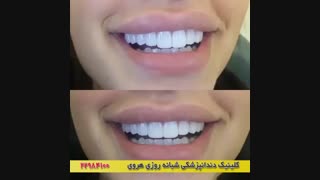 زیبایی دندانها