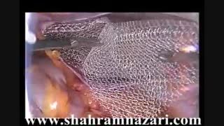 ترمیم لاپاروسکوپیک فتق بیضه توسط دکتر نظری ارتودنسی