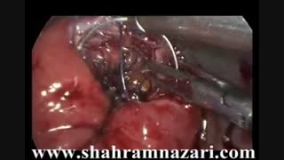 جراحی آندوسکوپیک داخل فضای روده برای تومور-دکتر شهرام نظری کلینیک دندانپزشکی