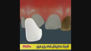 دندونام نیاز به ترمیم دارن, چیکار باید کنم؟