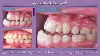 قبل و بعد ارتودنسی بیمار شماره 121 | دکتر همت پور